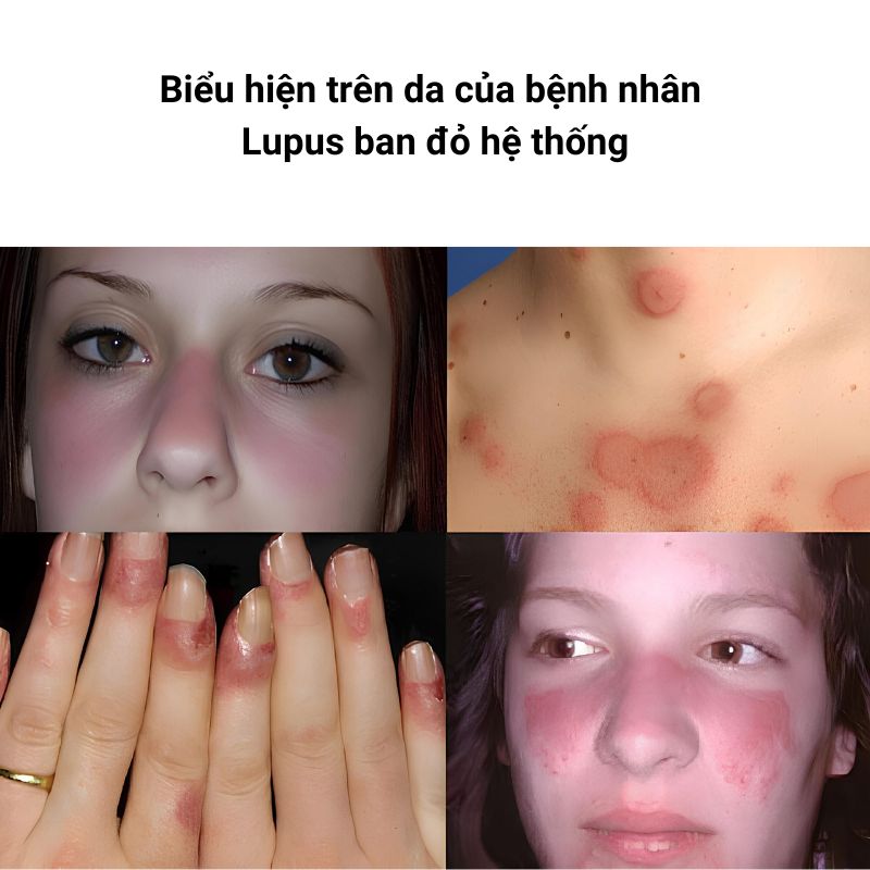 Bieu-hien-o-da-SLE