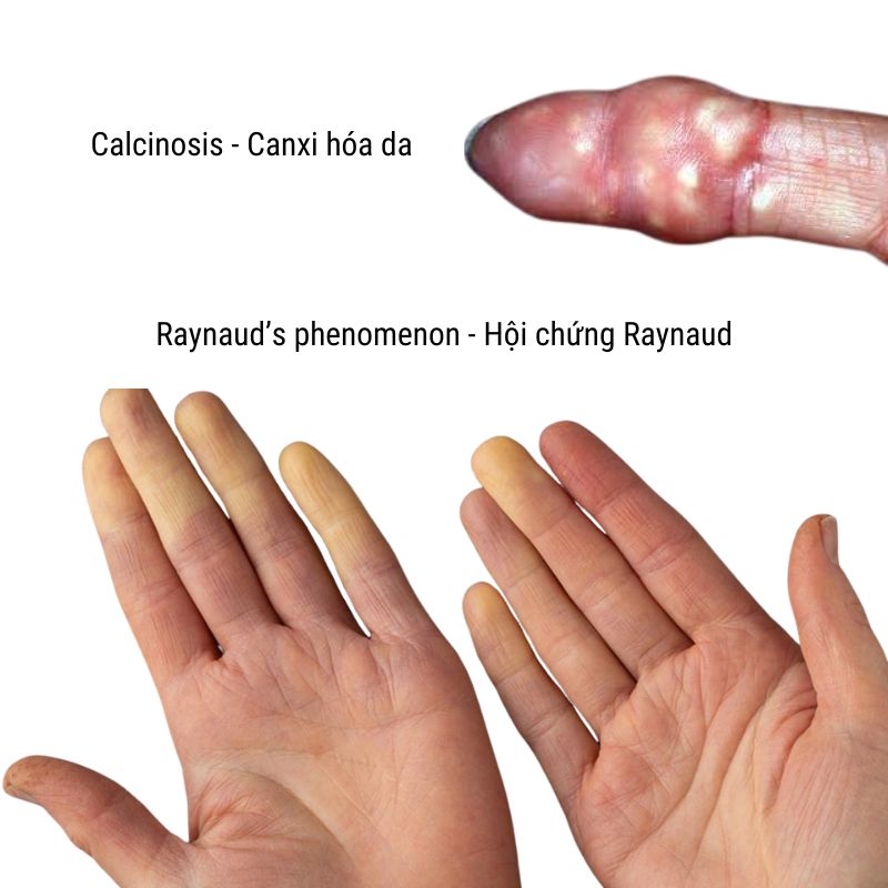 Calcinosis-Raynaud