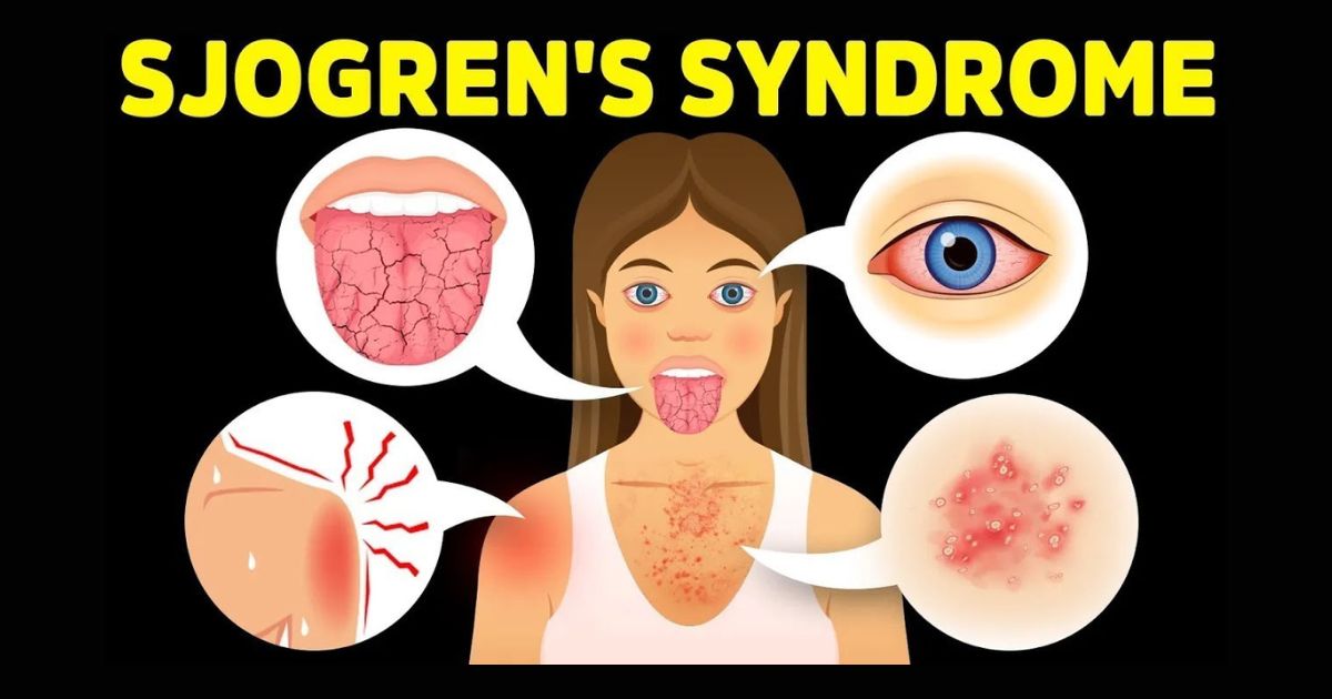 Chan-doan-Sjogren