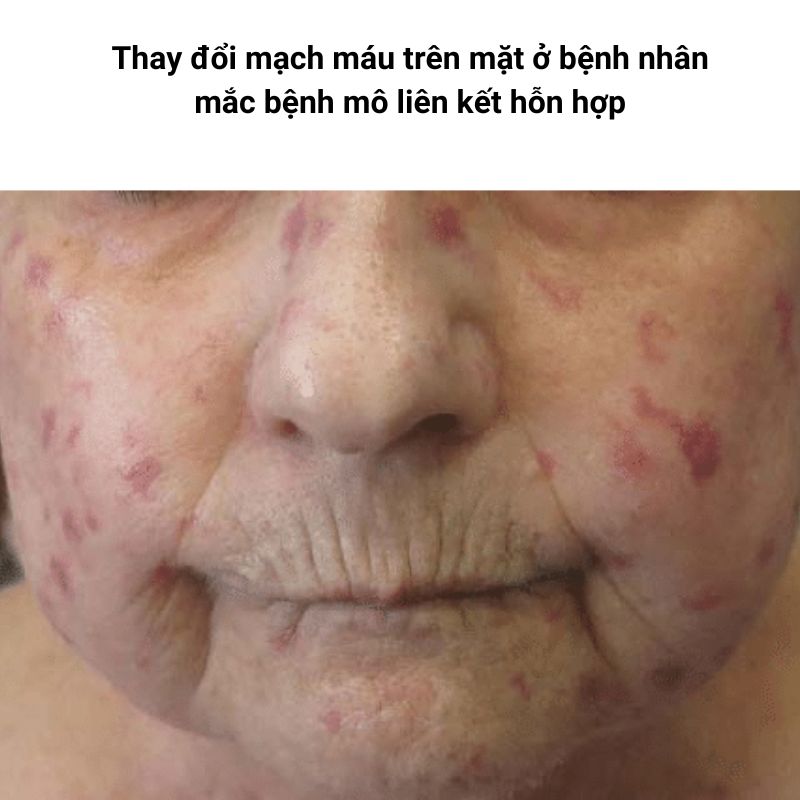 Benh-mo-lien-ket-hon-hop-MCTD