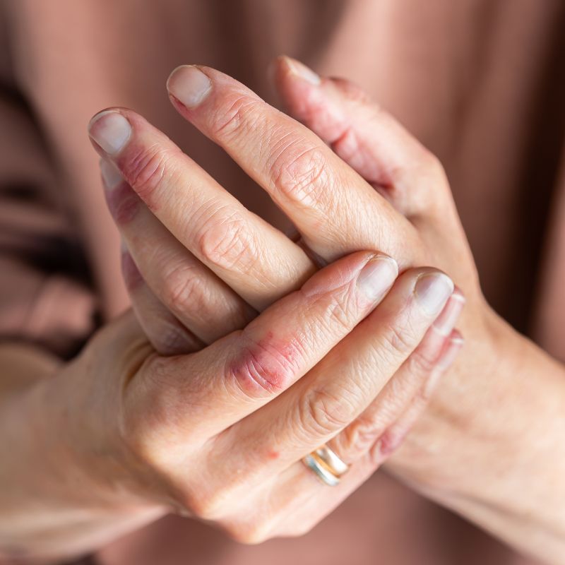 Bien-the-Dermatomyositis