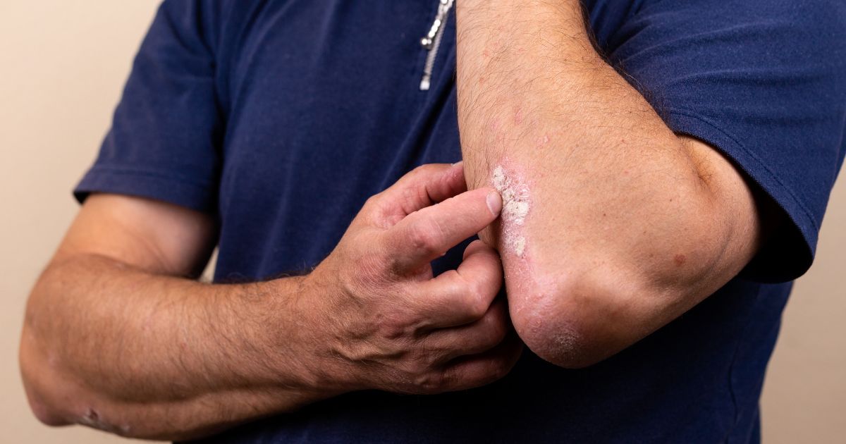 Chan-doan-Dermatomyositis