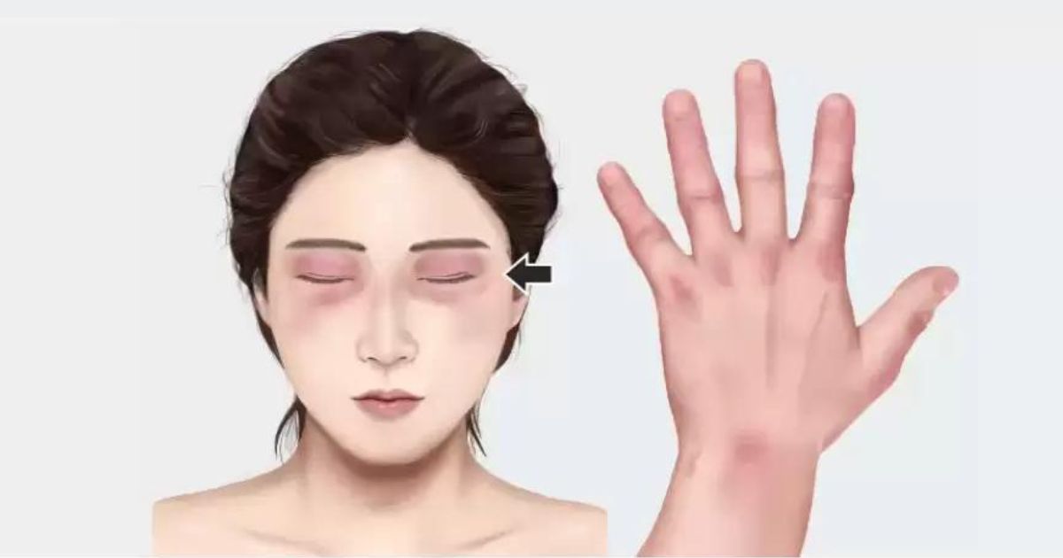 Dermatomyositis