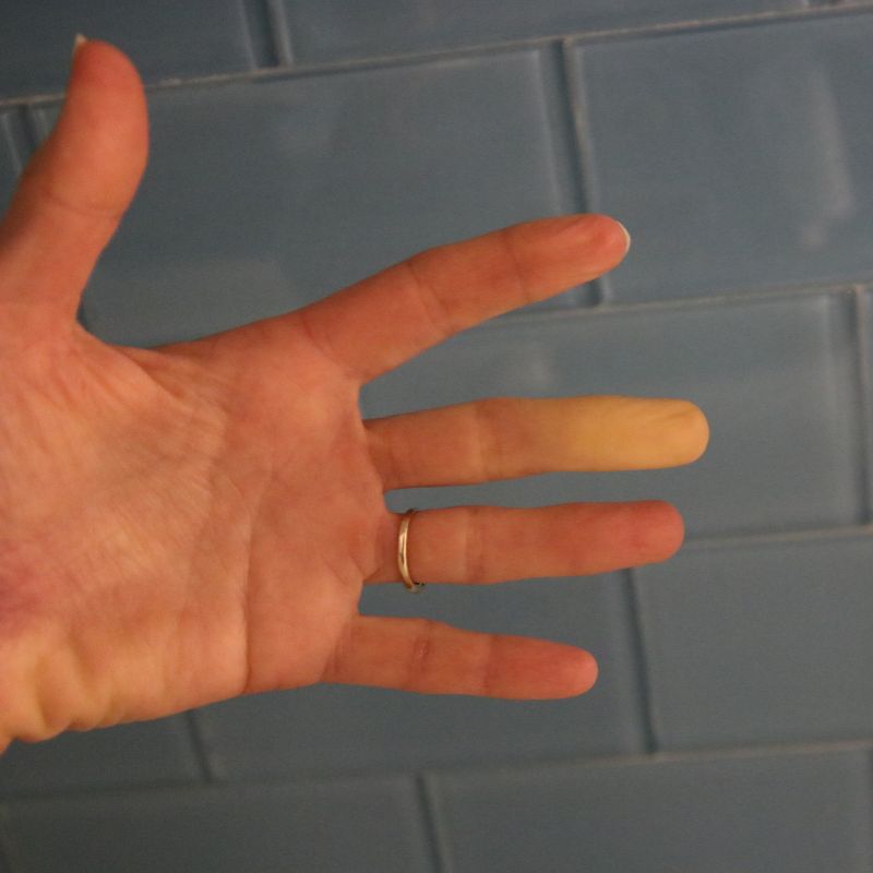 Raynaud