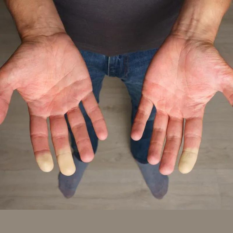 Raynaud