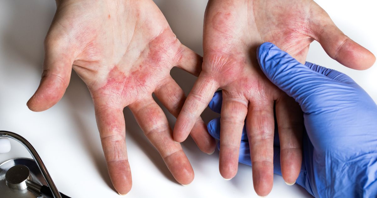 Tieu-chuan-chan-doan-Polymyositis-Dermatomyositis