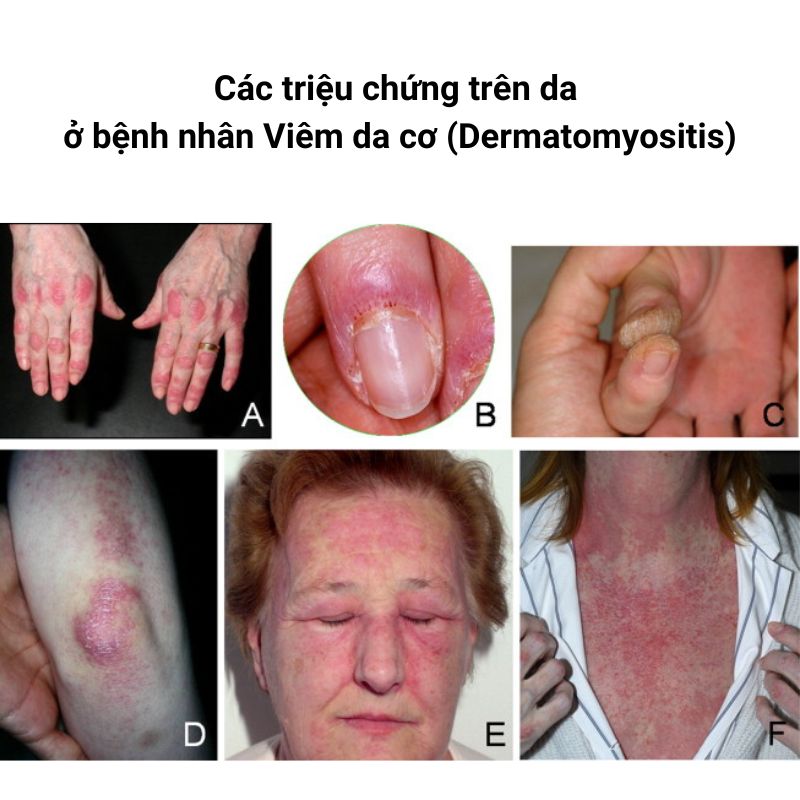 Trieu-chung-o-da-Dermatomyositis