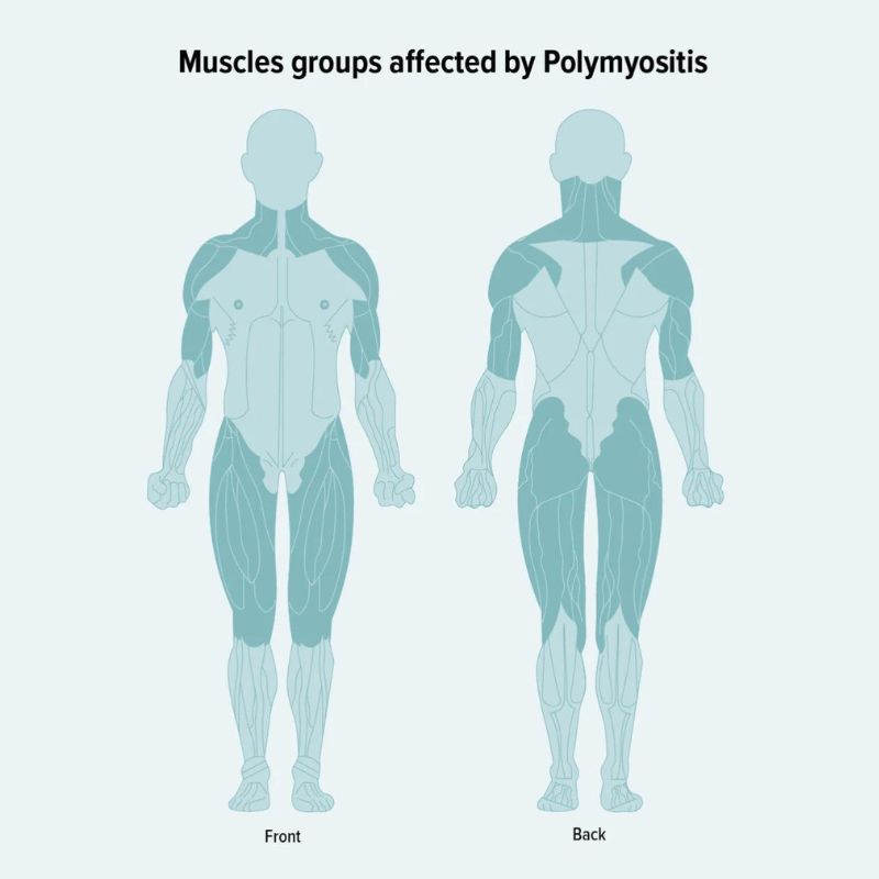 Vi-tri-co-anh-huong-Polymyositis