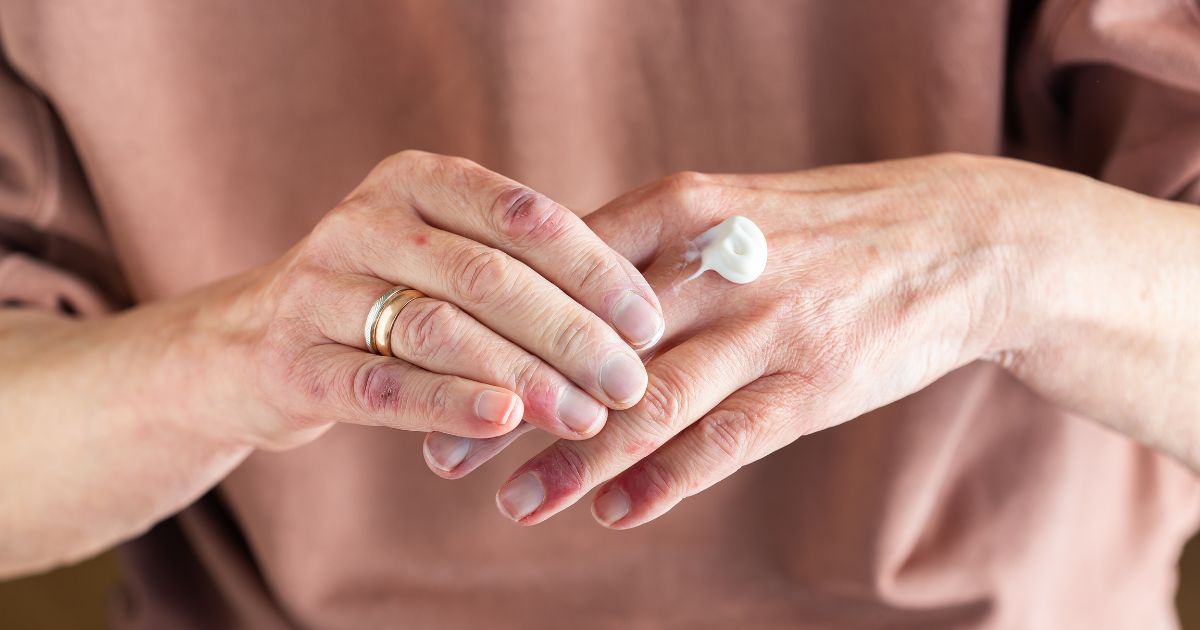 Viem-da-co-Dermatomyositis