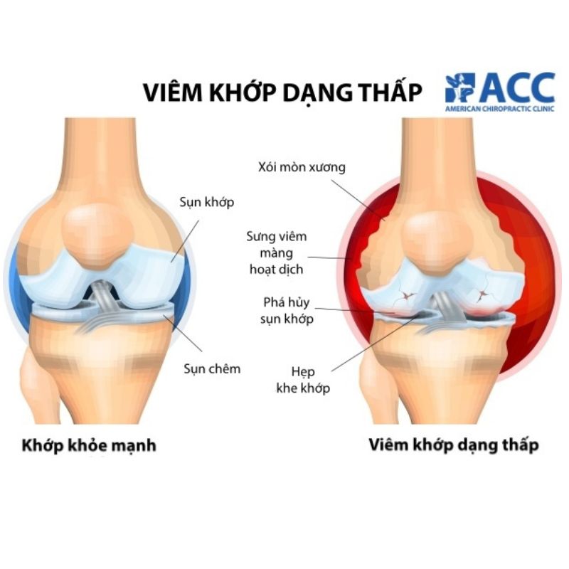Viem-khop-dang-thap
