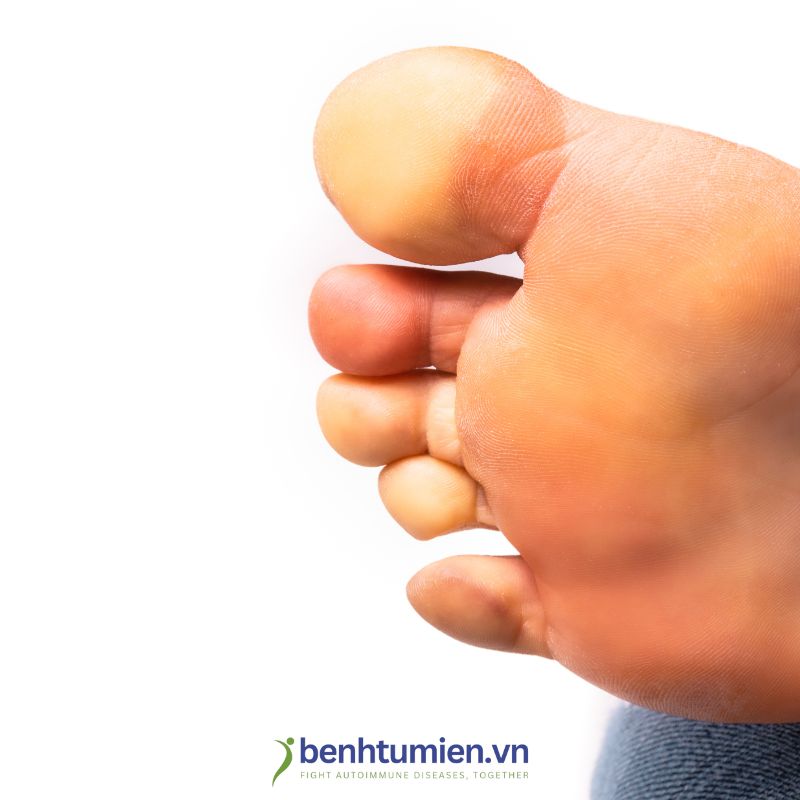 Hoi-chung-Raynaud
