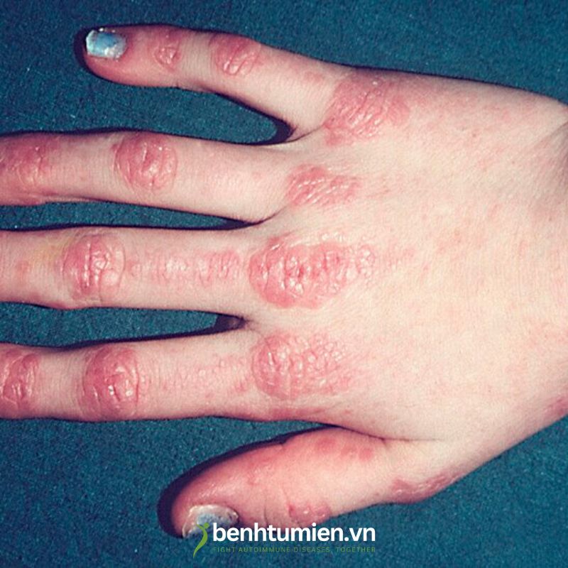 Viem-da-co-Dermatomyositis 