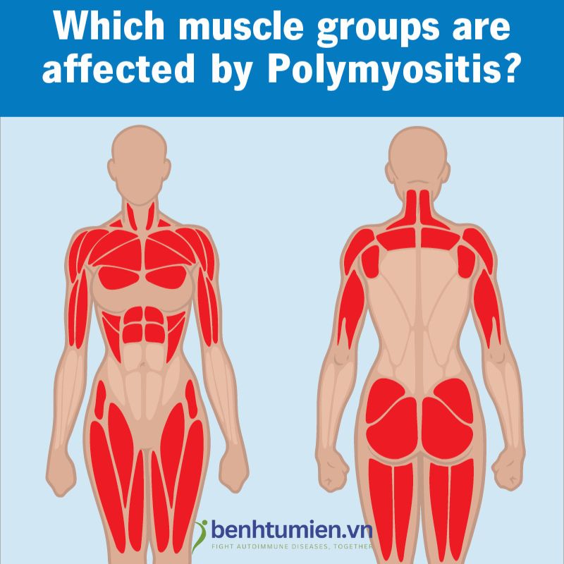 Viem-da-co-Polymyositis Viem-da-co-Polymyositis