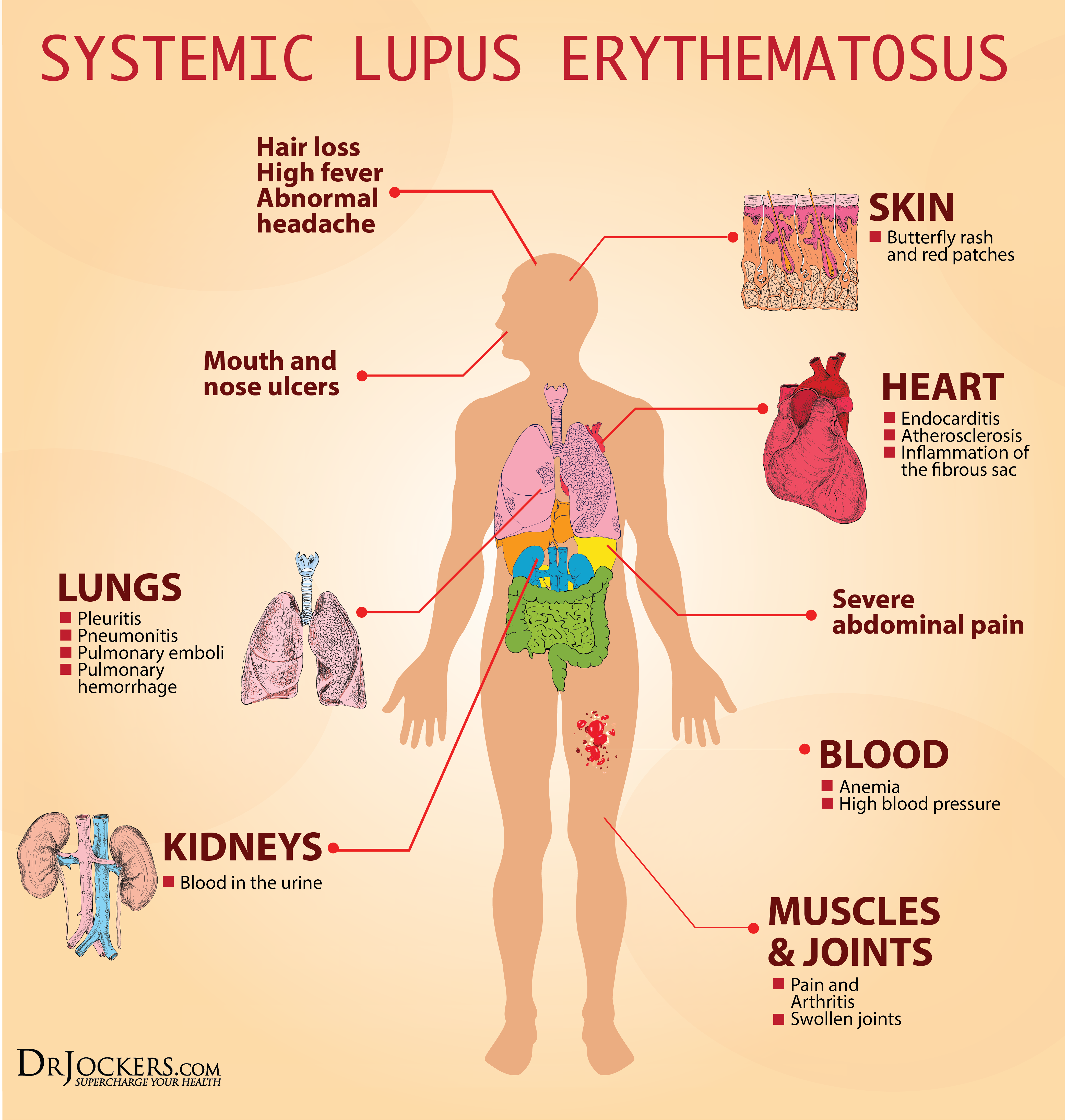 LUPUS_Symptoms LUPUS_Symptoms
