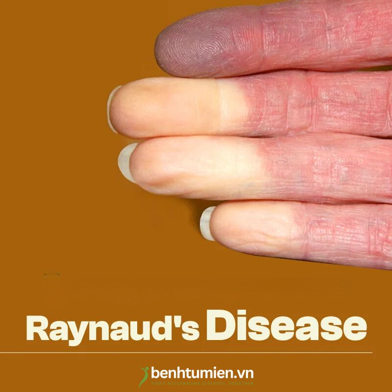 Raynaud