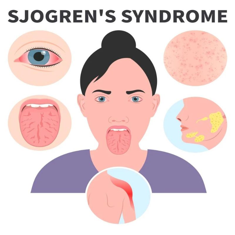 trieu-chung-Sjogren