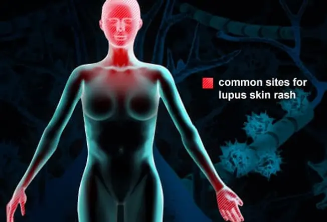 vi-tri-phat-ban-cua-lupus