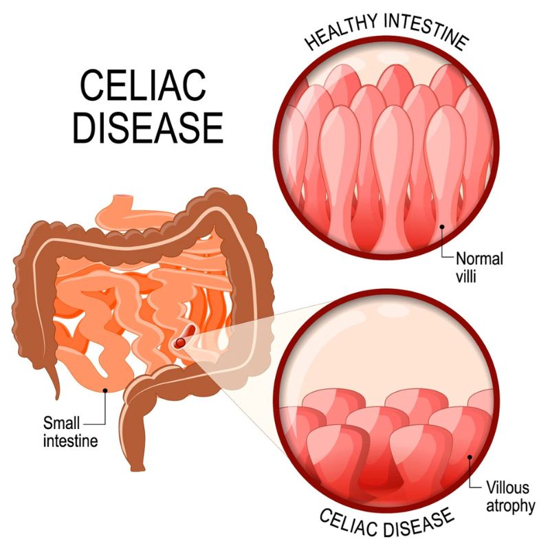 Benh-Celiac