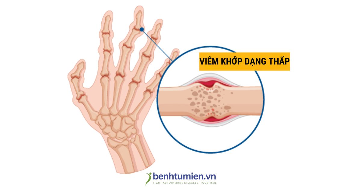 Dau-hieu-viem-khop-dang-thap