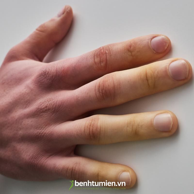 raynaud