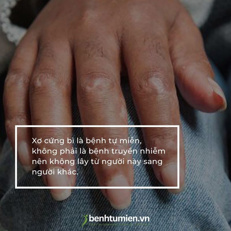 xo-cung-bi-khong-lay-nhiem
