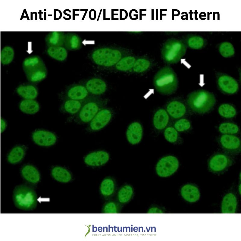 Vai trò của kháng thể anti-DFS70 trong chẩn đoán bệnh tự miễn - Benhtumien