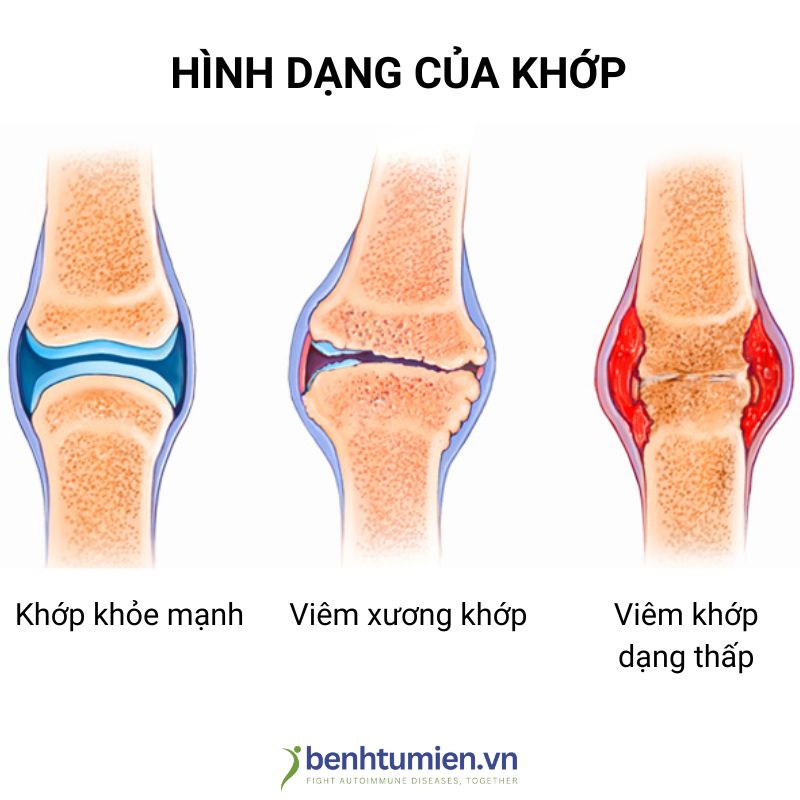viem-khop-dang-thap viem-khop-dang-thap