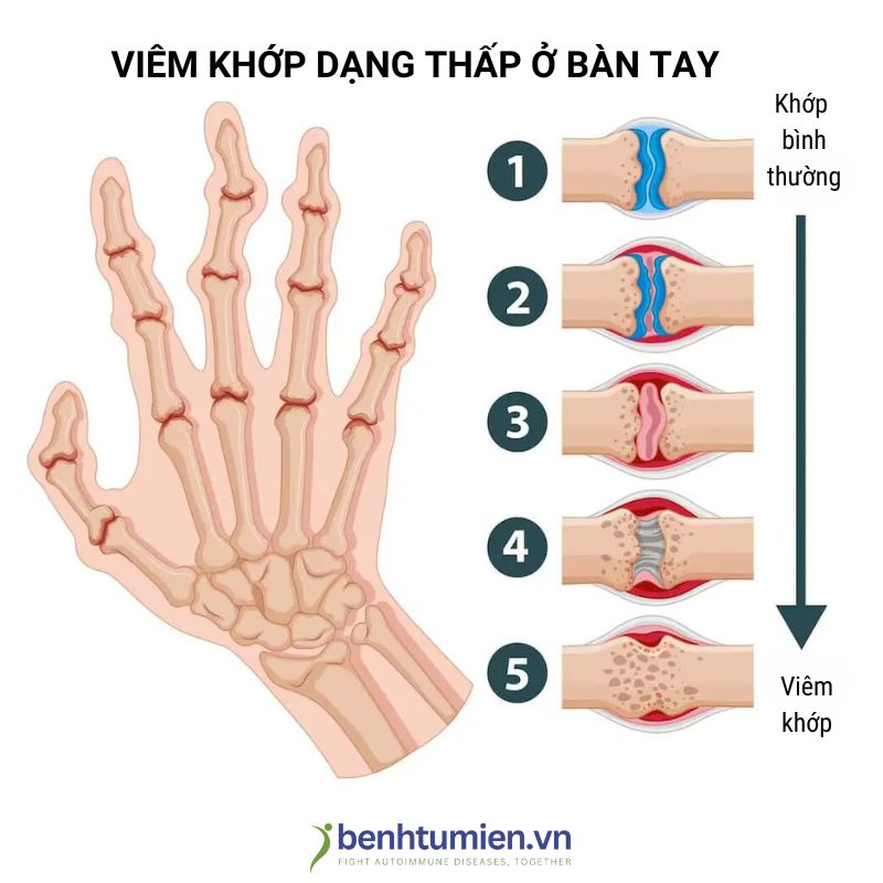 viem-khop-dang-thap