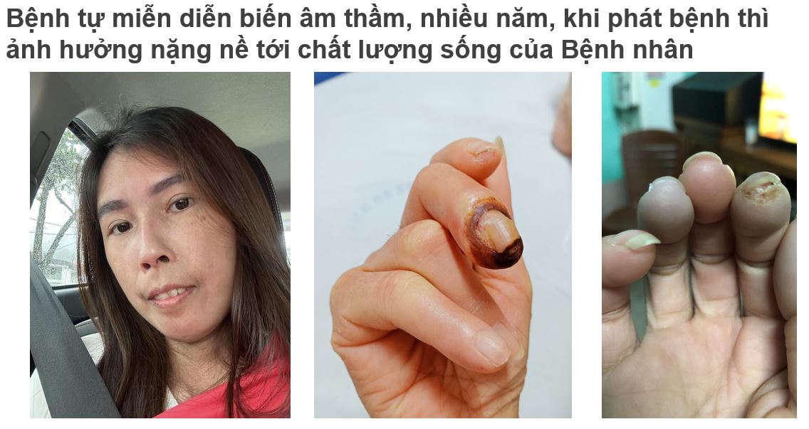 benh-tu-mien