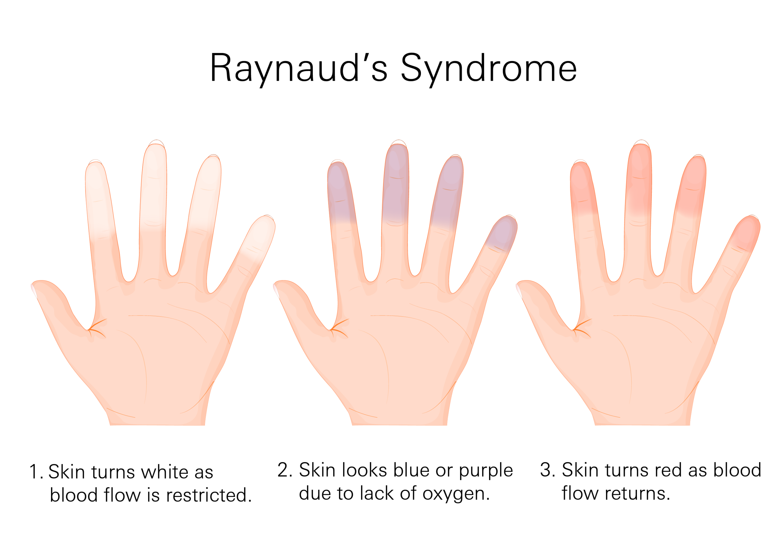 Hien-tuong-Raynaud-3-pha