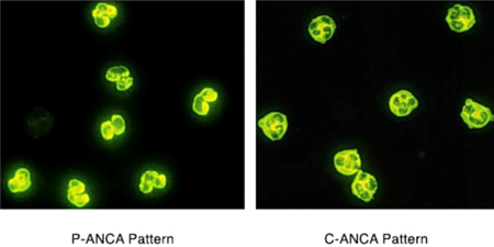 p-ANCA_vs_c-ANCA